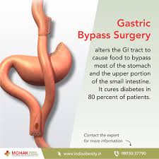Bariatric Surgery Is Very Effective In Type 2 Diabetes Consult A Bariatric Surgeon Now At 9893037790 And Get It Bariatric Surgeon Bariatric Surgery Bariatric