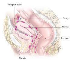 Uterine cancer may not cause symptoms, particularly in the early stages. Endometrial Ovarian And Cervical Cancer