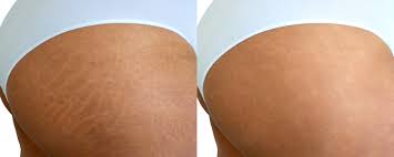 Laser stretch marks recovery and result: Stretch Mark Removal Nyc Laser Stretch Mark Removal Procedures