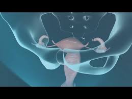 Tubal Ligation Surgery Youtube