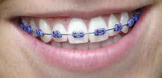 Green aqua akvarisztikai bolt és webáruház. Colored Braces And Bands Murray Orthodontics