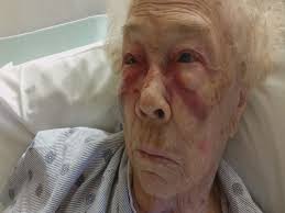 Sedated JCMC patient falls in operating room after someone ‘looked away’