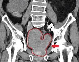 Prostate cancer is a common type of cancer in men, according to the mayo clinic. Prostate Cancer Wikipedia