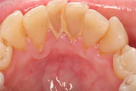 To prevent excessive plaque buildup in between visits to your dentist, keep the following. At Home Tartar Removal Fr Dental Budapest
