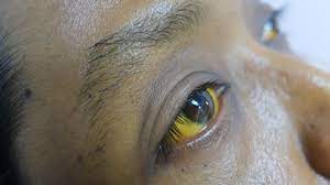 We did not find results for: Mengungkap Fakta Di Balik Sakit Kuning Info Sehat Klikdokter Com