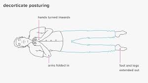 Decorticate Posturing Symptoms And Causes