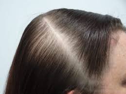 The deficiency can then lead to thinner hair. Female Hair Thinning Success Story