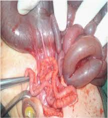 Congenital Colonic Atresia Case Reports T Journal Of Pediatrics Neonatal Care