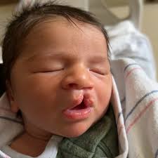 Image result for Cleft Lip