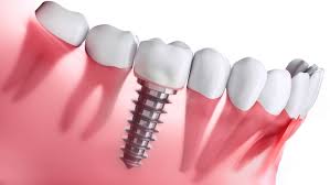 Image result for dental implant
