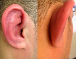 Dedesi yine pazarcığın aşiret reisi bilal ağa'dır. Polykondritt Relapsing Polychondritis Vaskulitt Novaskulitt No