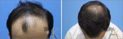 Find and book appointment with some of the best and top hair loss treatment in south delhi, delhi at 365doctor.in. Hair Loss Treatment In Delhi Best Hair Fall Treatment Clinic In South Delhi India