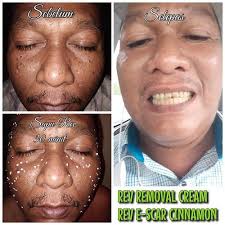 Aku disuruh berbaring di atas tempat tidur, ya mirip blankar rumah sakit cuma ini lebih nyaman. Set Rev Removal Cream