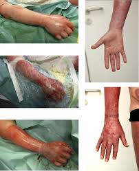 Escharotomy is surgical incision through the eschar to release the constriction, thereby restoring distal circulation and allowing for adequate ventilation. Feasibility And Safety Of Enzymatic Debridement For The Prevention Of Operative Escharotomy In Circumferential Deep Burns Of The Distal Upper Extremity Surgery