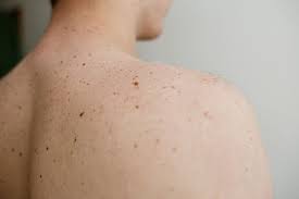 If you aren't sure which type of skin cancer. Skin Cancer Causes Symptoms Treatment And Prevention