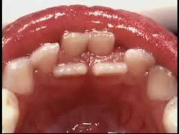 Bahan pdp dst@fb_nmr • tidak kuat bahan pdp dst@fb_nmr • bersifat sementara • akan gugur dan digantikan dengan gigi kekal bermula pada umur 6 tahun. Perlu Ke Cabut Gigi Susu Anak Yang Dah Goyang Kedai Vitamin Butterworth