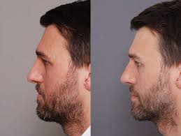 UK's Leading Rhinoplasty Surgeon │ Charles East