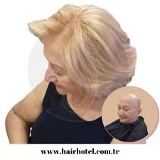 Kadinlarda Sac Dokulmesi Sac Dokulmesi Sac Dogal Sac