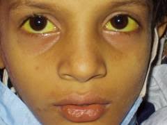 Hasil gambar untuk penyakit hepatitis pada manusia