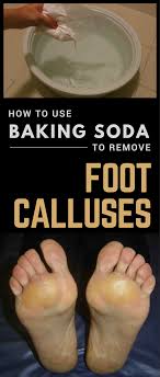 A foot file is another tool for exfoliation. How To Use Baking Soda To Remove Foot Calluses Foot Callus Callus Remover Diy Best Callus Remover