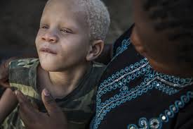 Syna jsem nechtěla ani kojit. Chtěla jsem od něj utéct,” říká matka chlapce  s albinismem