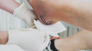 We did not find results for: Types Of Wound Healing Primary Secondary Tertiary And Stages