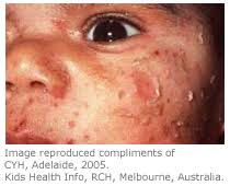Image result for yellow scabs on the face in children