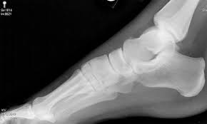 Proximal fifth metatarsal fractures have different treatments depending on the location of the fracture. Talar Avulsion Fracture Ortho Teaching Files Nuem Blog