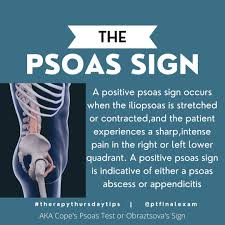 Image result for Psoas Sign