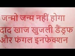 द द ख ज ख जल फ गल क पक क इल ज एक ब र म Ringworm Dad Khaj Khujali Fungal Infection Ka Ilaj Y Fungal Infection Skin Skin Diseases Home Health Remedies