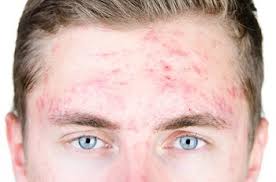 Dans cette vidéo, vous allez regarder l'émission sur l'extraction de l'acné sur. Huiles Essentielles Contre L Acne Et Les Boutons Traitement Naturel