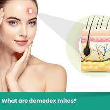 Demodex mites make hair to fall out when they infest in large numbers. Zahra On Twitter Ungex Hairloss Hair Treatment Acne Demodexmitestreatment Ungexproducts Https T Co Uivtfq8kz7 If Demodex Mites Population Grow Hair Loss Will Be One Of Their Existence Consequences As A Result Wiping Out The Source