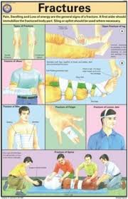 Fractures Chart First Aid Charts Maps Charts