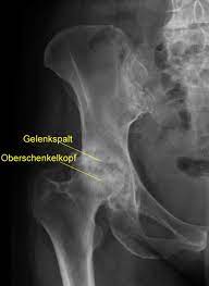 Huftarthrose Coxarthrose Gelenkerhaltende Therapie Des Huftgelenks Gelenk Klinik De
