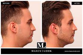 Located at ion orchard, the covette clinic was recently awarded 'the aesthetic clinic of the year asia pacific, 2018' by global health . Masculinization Treatment Castelblanque Aesthetic Clinic Denia Com