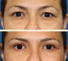 Drooping Eyelid Surgery Google Search Natural Remedies Natural Skin Care Eye Surgery