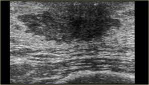 Ultrasound follow up breast ultrasound is among the most common modalities used in although male breast cancer is rare, it's important to watch for symptoms like breast lumps, skin what does an abnormal mammogram look like? The Radiology Assistant Pathology Of The Male Breast