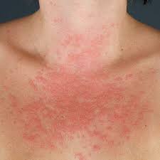 Image result for polymorphous eruption