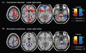 Image result for Conversion Disorder