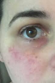 Maybe you would like to learn more about one of these? Silicone Scar Sheets Before And After Pictures Silicone Sheets For Scars