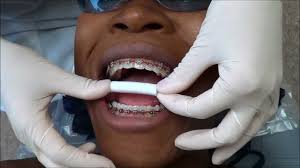 The cold temperature provides a numb sensation in the mouth and decreases inflammation in the sore gums. What Does It Feel Like When Braces Are Removed Orthodontic Associates