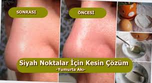 Burundaki Siyah Noktalar Icin Yumurta Aki Ile Kurler Siyah Noktalar Siyah Nokta