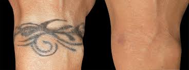 Trusted medical aesthetics serving fayetteville, ar. Laser Tattoo Removal Experts Long Island Perfect Body Laser Aesthetics Long Island Ny