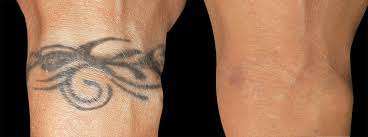 Tattoo shop located in central islip. Laser Tattoo Removal Experts Long Island Perfect Body Laser Aesthetics Long Island Ny