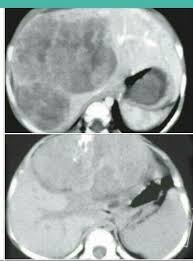 Ncct awards ceus based on the length of the training, see chart for details. Ncct Scan In A 14 Month Old Male Patient With Hepatoblastoma Shows A Large Well Defined Hypodense Mass Replacing The Left L Radiology 14 Month Old Enhancement