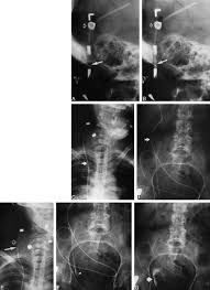The Adult Radiographic Shuntogram American Journal Of Neuroradiology