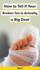 Common toe related injuries are: How To Tell If Your Broken Toe Is Actually A Big Deal Broken Toe Broken Big Toe Toes