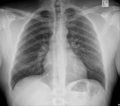 Chest Supine View Radiology Reference Article Radiopaedia Org