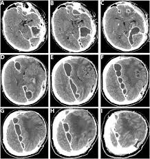 Image result for Brain Abscess
