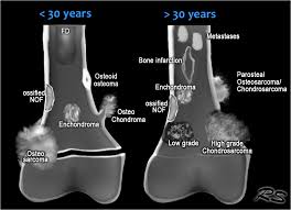 The Radiology Assistant Bone Sclerotic Tumors And Tumor Like Lesions